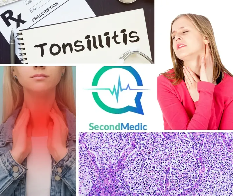 Tonsillitis medical second opinion Blog Image