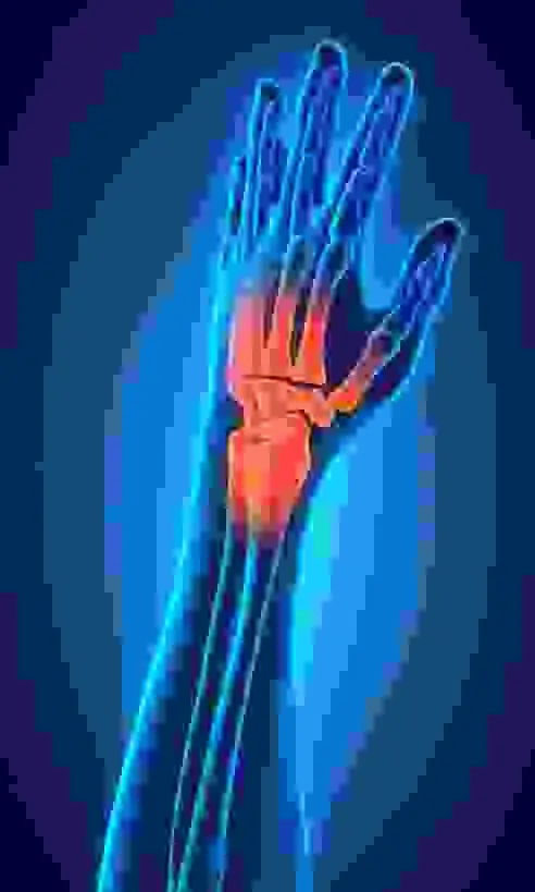A wrist fracture can mean that a person has broken 