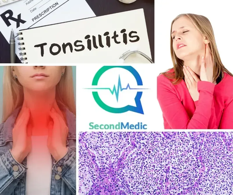 Tonsillitis Causes Symptoms Diagnosis And Treatment