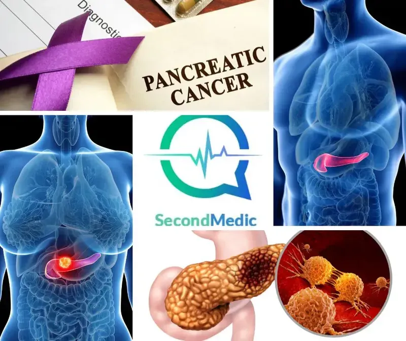Pancreatic Cancer - Cause Symptoms Diagnosis & Treatment