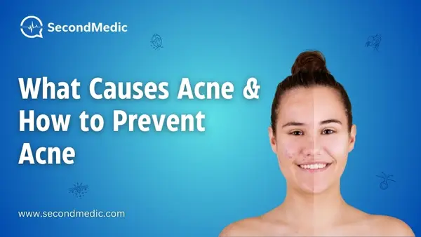 How to Prevent Acne?