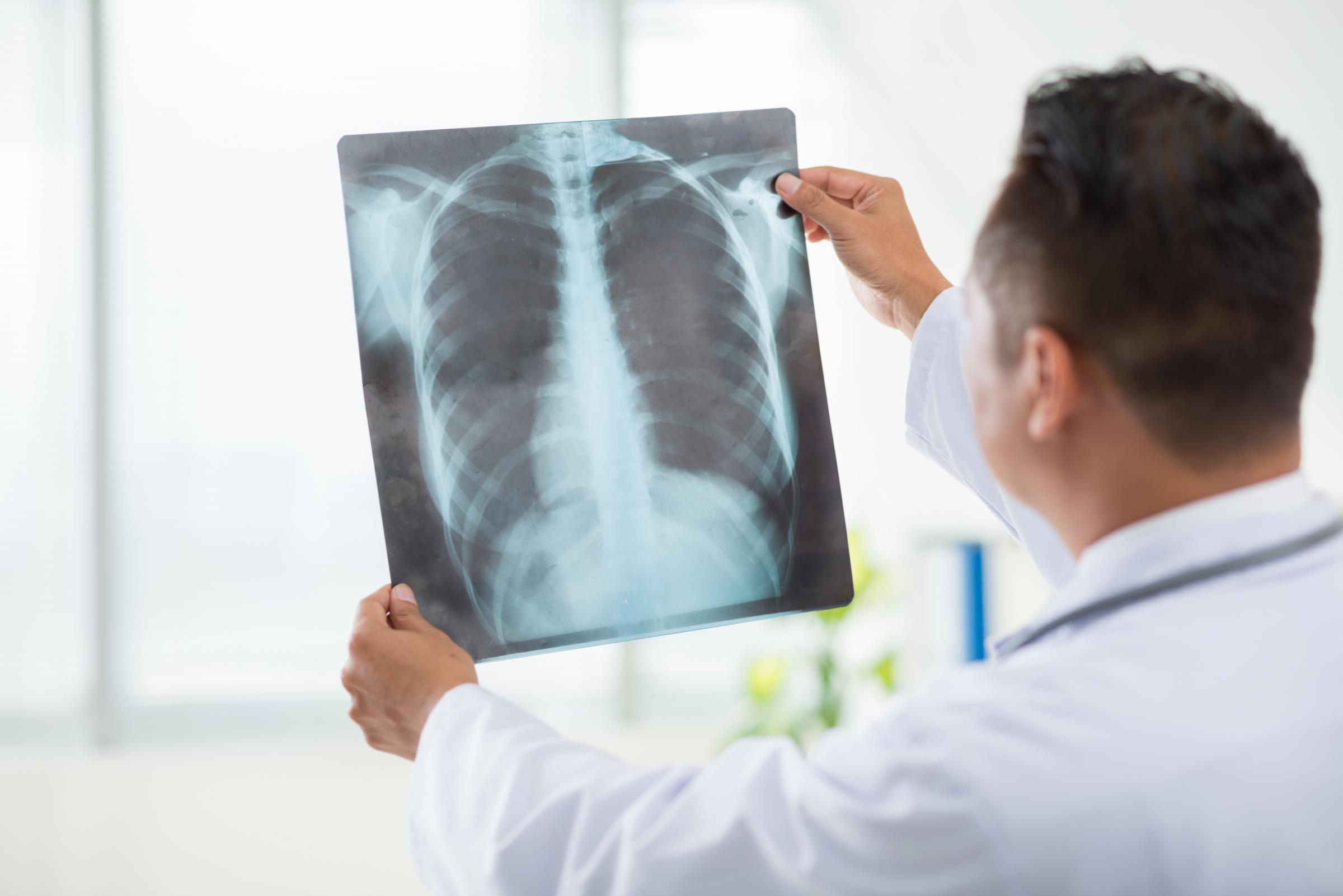 X-Ray Dorsal Spine Lat
