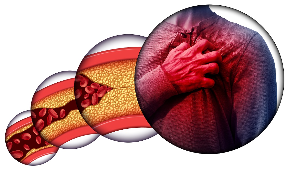 LIPID PROFILE